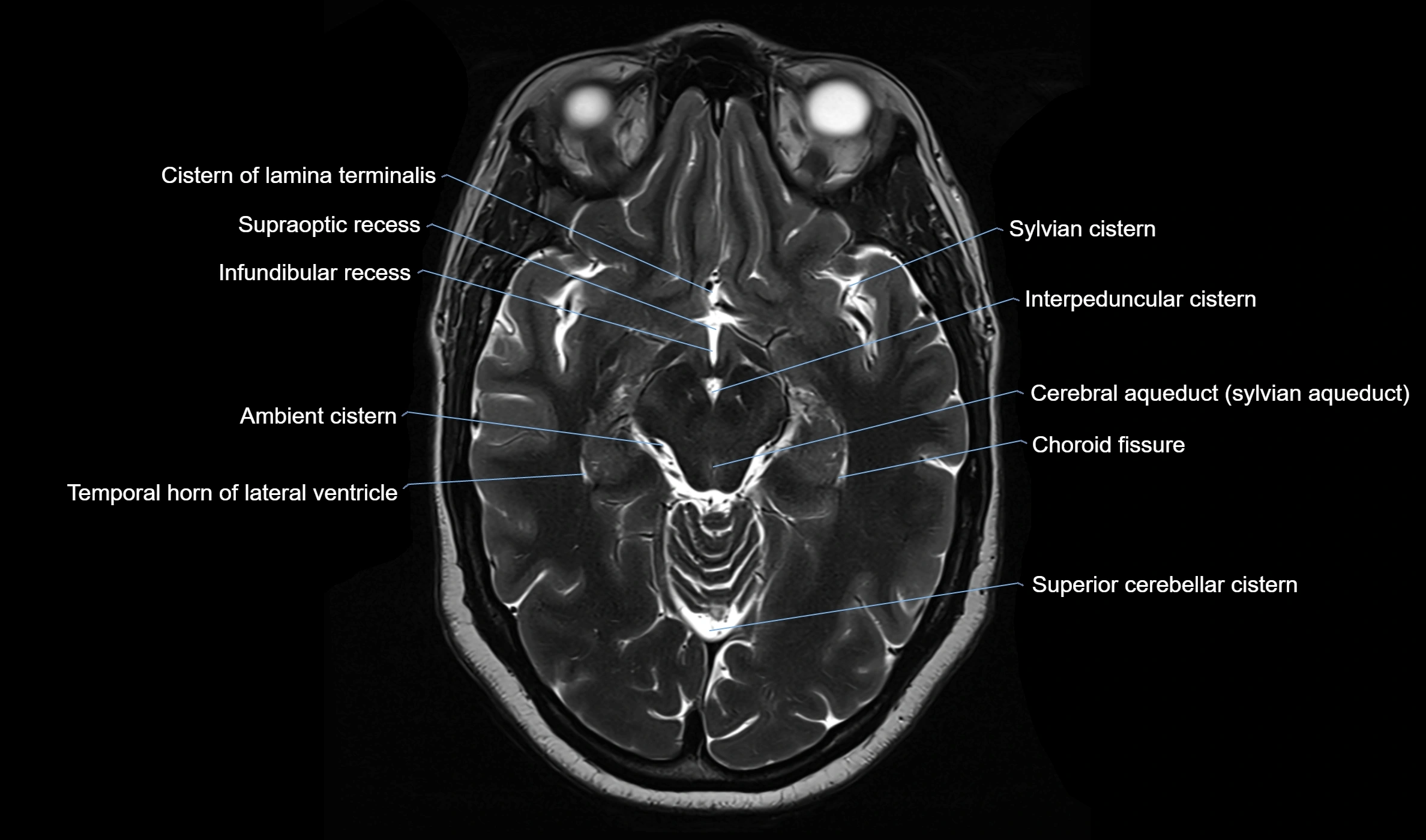 Brain cisterns  and ventricles  axial anatomy 3T MRI image-img-00001-00023.webp
